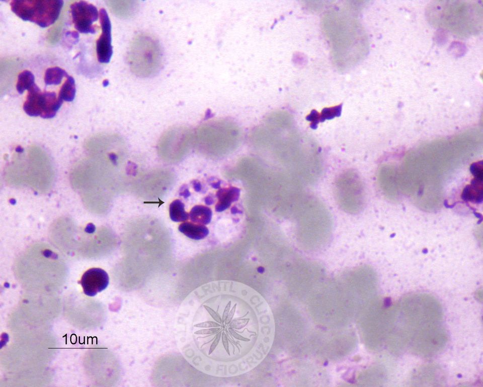 Um neutrófilo contendo diversas amastigotas em seu interior (seta).
				[Notar a presença de membrana celular, núcleo e cinetoplasto nas amastigotas].