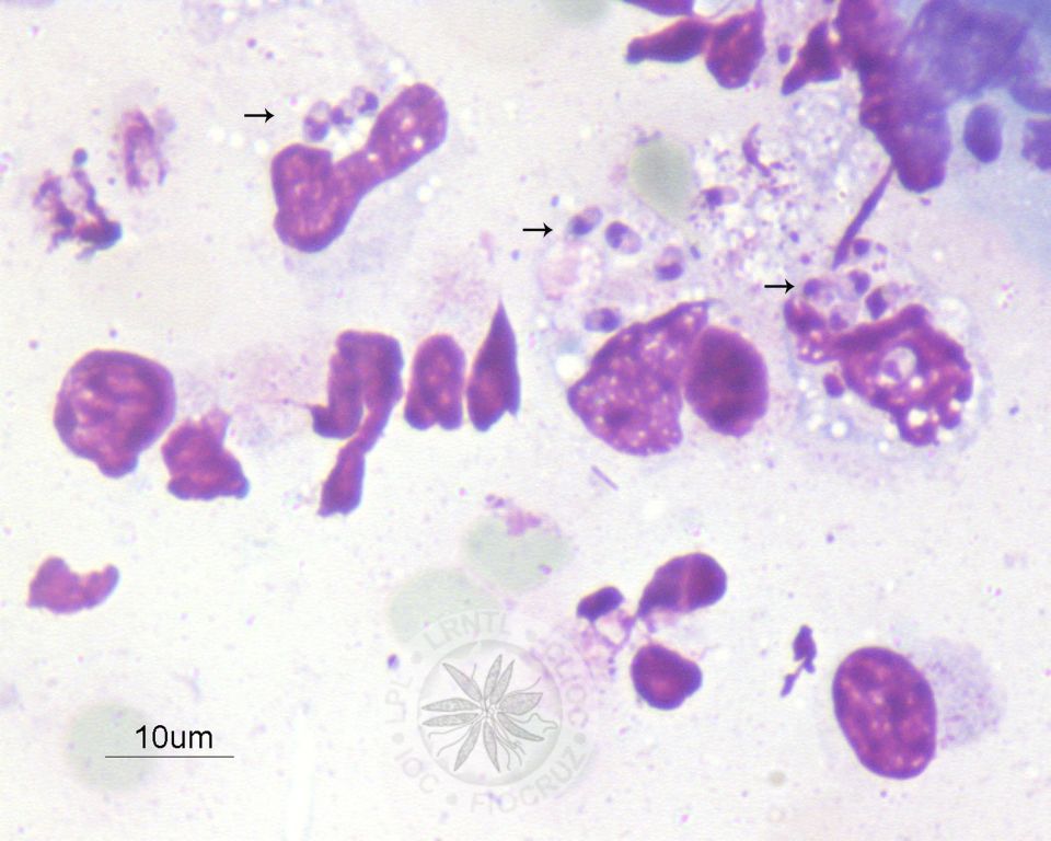 Diversas amastigotas são observadas no interior de três macrófagos (setas).
				[Notar a presença de membrana celular, núcleo e cinetoplasto nas amastigotas].