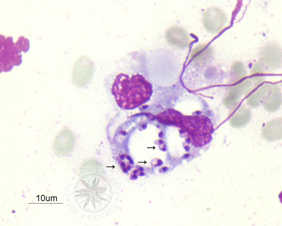 Diversas amastigotas são observadas em vacúolos em um macrófago (setas). 
				[Notar a presença de membrana celular, núcleo e cinetoplasto nas amastigotas].