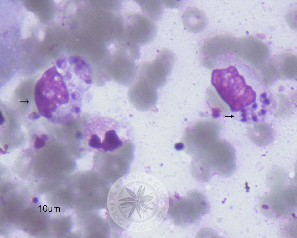 Dois macrófagos contendo diversas amastigotas em seu interior (setas).  
				[Notar a presença de membrana celular, núcleo e cinetoplasto nas amastigotas].