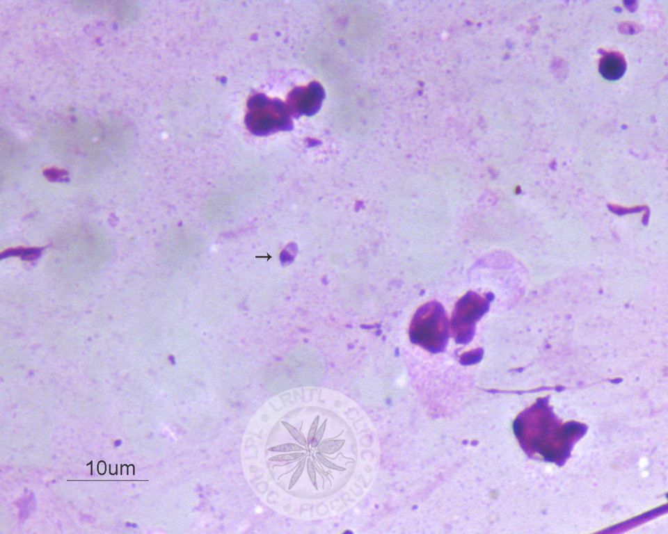 Uma amastigota é vista nesta imagem (seta).
				[Notar a presença de membrana celular, núcleo e cinetoplasto nas amastigotas].